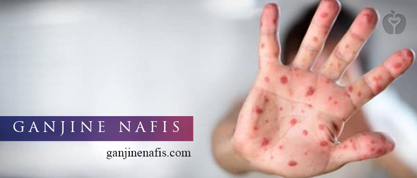 واکسن آبله‌مرغان در راه است